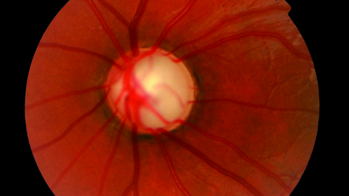 Glaucoma congnito