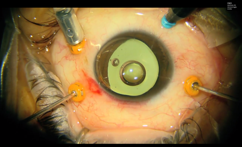 Vitrectoma