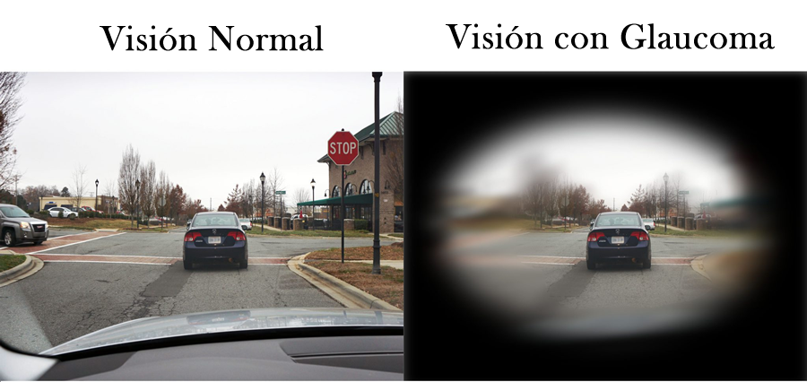 Glaucoma